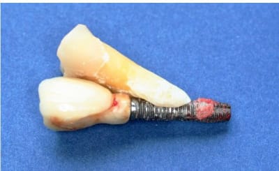 Implantes 2 m0uyas - Eugenol