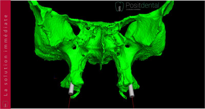 Implants ptérygoïdien 003 eilzck - Eugenol