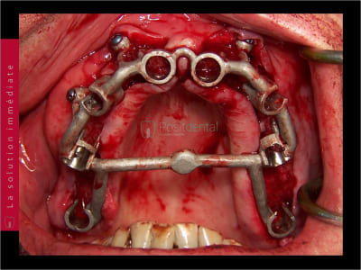 Implants ptérygoïdien 036 qyrfqm - Eugenol