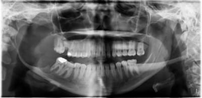 Kyste mahousse xp9ylm - Eugenol