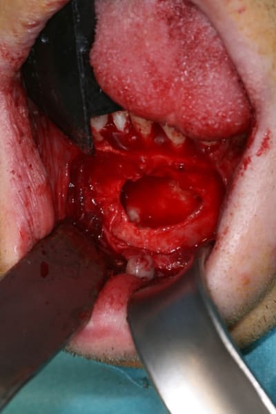 Kyste mand03 aii4mq - Eugenol