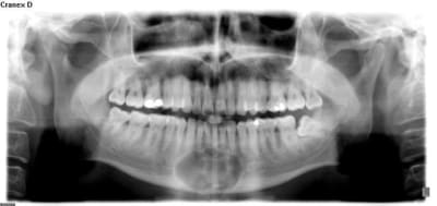 Kyste mand ea1mxb - Eugenol