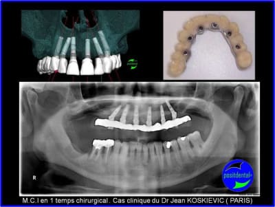 M.c.i en 1 temps chirurgical  - Eugenol