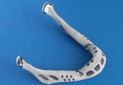 Maxillaire titane zxnmj2 - Eugenol