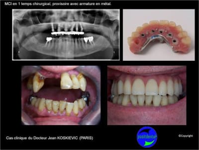 Mci mise en charge imm diate 003 vgfsj5 - Eugenol