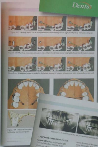 Mini implants du0bdl - Eugenol