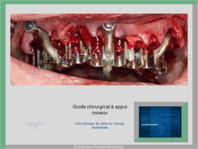 Mise en charge immédiate   immediate loading  hardware manufacturer - Eugenol