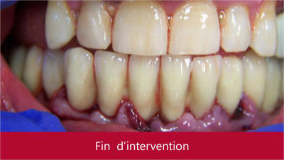 Mise en charge immédiate   protocole positdental 004 g7oztt - Eugenol