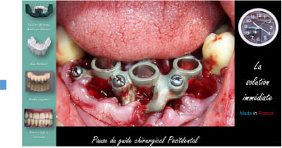 Mise en charge immédiate   protocole positdental 011 xaqmp9 - Eugenol