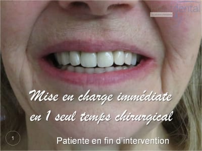 Mise en charge immédiate   chirurgie guidée 01 jcxpho - Eugenol