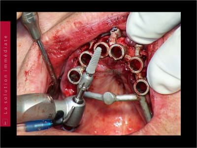 Mise en charge immédiate   chirurgie guidée guide chirurgical 044 hhd0gp - Eugenol