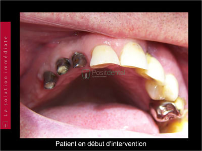 Mise en charge immédiate   chirurgie guidée guide chirurgical a 001 gvfqgr - Eugenol