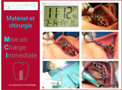 Mise en charge immédiate 008 tckuos - Eugenol