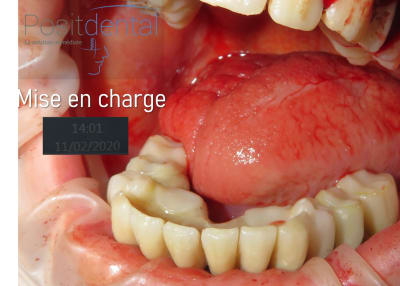 Mise en charge immédiate positdental003 xixru6 - Eugenol