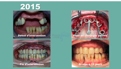 Mise en charge immédiate positdental 02 q1qekt - Eugenol