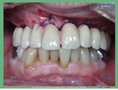 Mise en charge immédiate positdental r - Eugenol