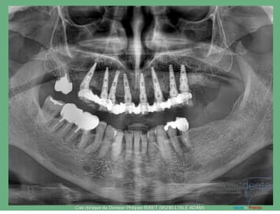 Mise en charge immédiate positdental r - Eugenol