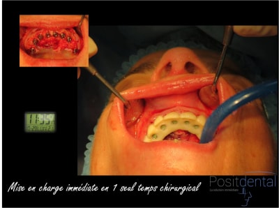 Mise en charge immédiate chirurgie guidée 010 gutuin - Eugenol