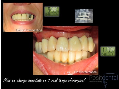 Mise en charge immédiate chirurgie guidée s6qowl - Eugenol