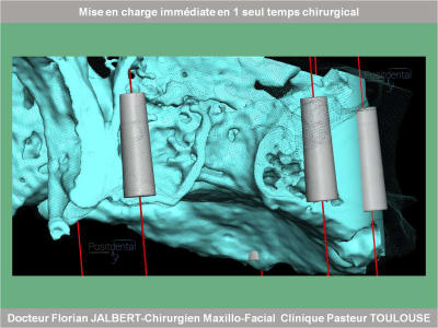 Mise en charge immédiate en 1 seul temps chirurgical protocole positdental 056 alkrta - Eugenol