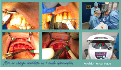 Mise en charge immédiate en 1 seule intervention la solution immédiate positdental 005 kut2xu - Eugenol