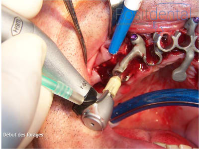 Mise en charge immédiate en chirurgie guidée   positdental 014 rdlc2v - Eugenol