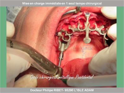 Mise en charge immédiate en chirurgie guidée positdental 000 xlixmn - Eugenol