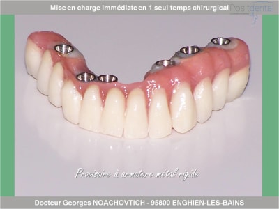 Mise en charge immédiate en chirurgie guidée positdental 008 ebwgus - Eugenol