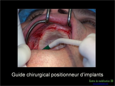 Mise en charge immédiate implant dentaire 026 tcc6rp - Eugenol