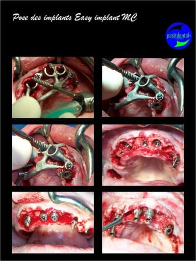 Mise en charge imm diate bridge provisoire sur implants 5 qgeery - Eugenol
