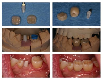 Montage implant 36  pilier zr c ram empress  riqied - Eugenol