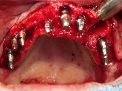 Positdental 2013 07 c - Eugenol