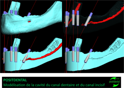 Positdental mod lisation de la cavit  du canal dentaire ctxzdq - Eugenol