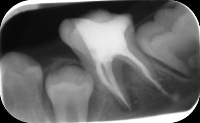 Post op2 hvhcb9 - Eugenol