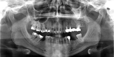 Pac pano v4hp2e - Eugenol