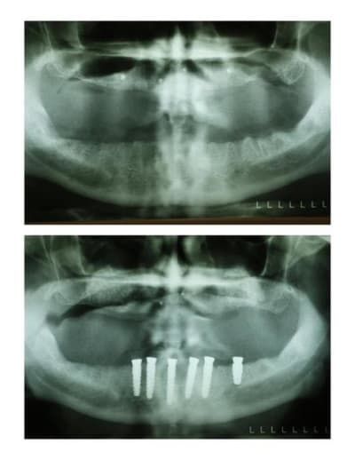 Pano implants  custom  do5i1p - Eugenol