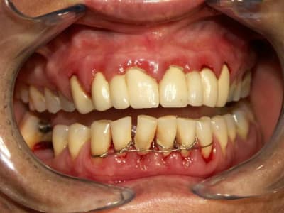 Patiente 1 doirb4 - Eugenol