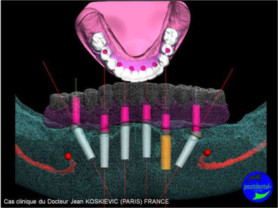 Planification implantaire assist e par ordinateur  guide radio opaque 1 f2ecyv - Eugenol
