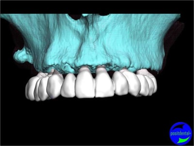 Positdental 004 gi5pyp - Eugenol