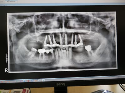 Positdental 180619 206 tije6d - Eugenol