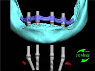 Positdental all on four 55 zdwzuu - Eugenol