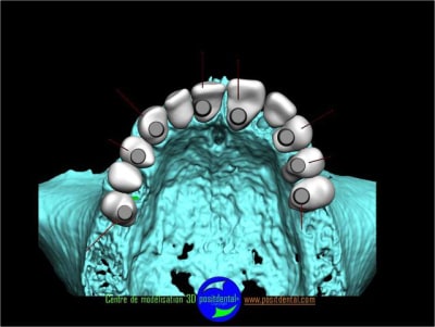 Positdental planification 3d 2 - Eugenol