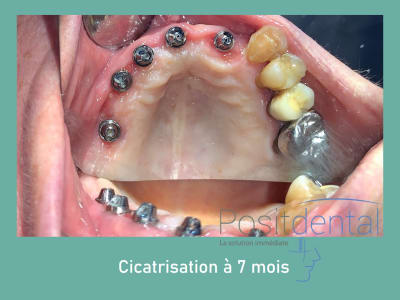 Positdental mise en charge immédiate 001 nwkqco - Eugenol