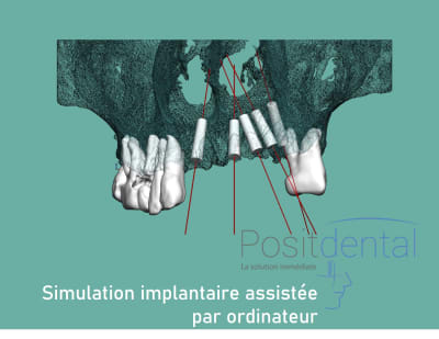 Positdental mise en charge immédiate 002 sgneo4 - Eugenol