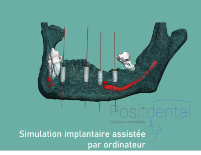 Positdental mise en charge immédiate 003 d805at - Eugenol