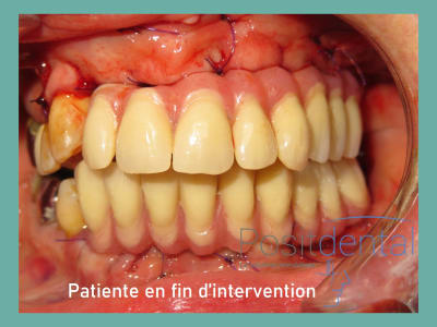 Positdental mise en charge immédiate 014 zun4mo - Eugenol