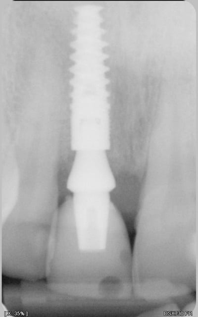 Post op hpa0rh - Eugenol