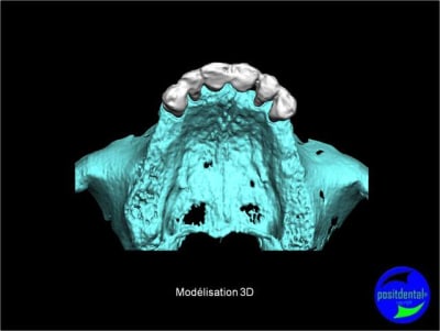 Protocole mci post extractionnelle positdental 003 flwvos - Eugenol