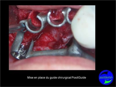 Protocole mci post extractionnelle positdental 010 ihi5c8 - Eugenol