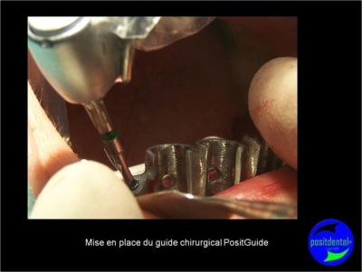 Protocole mci post extractionnelle positdental 011 myrity - Eugenol